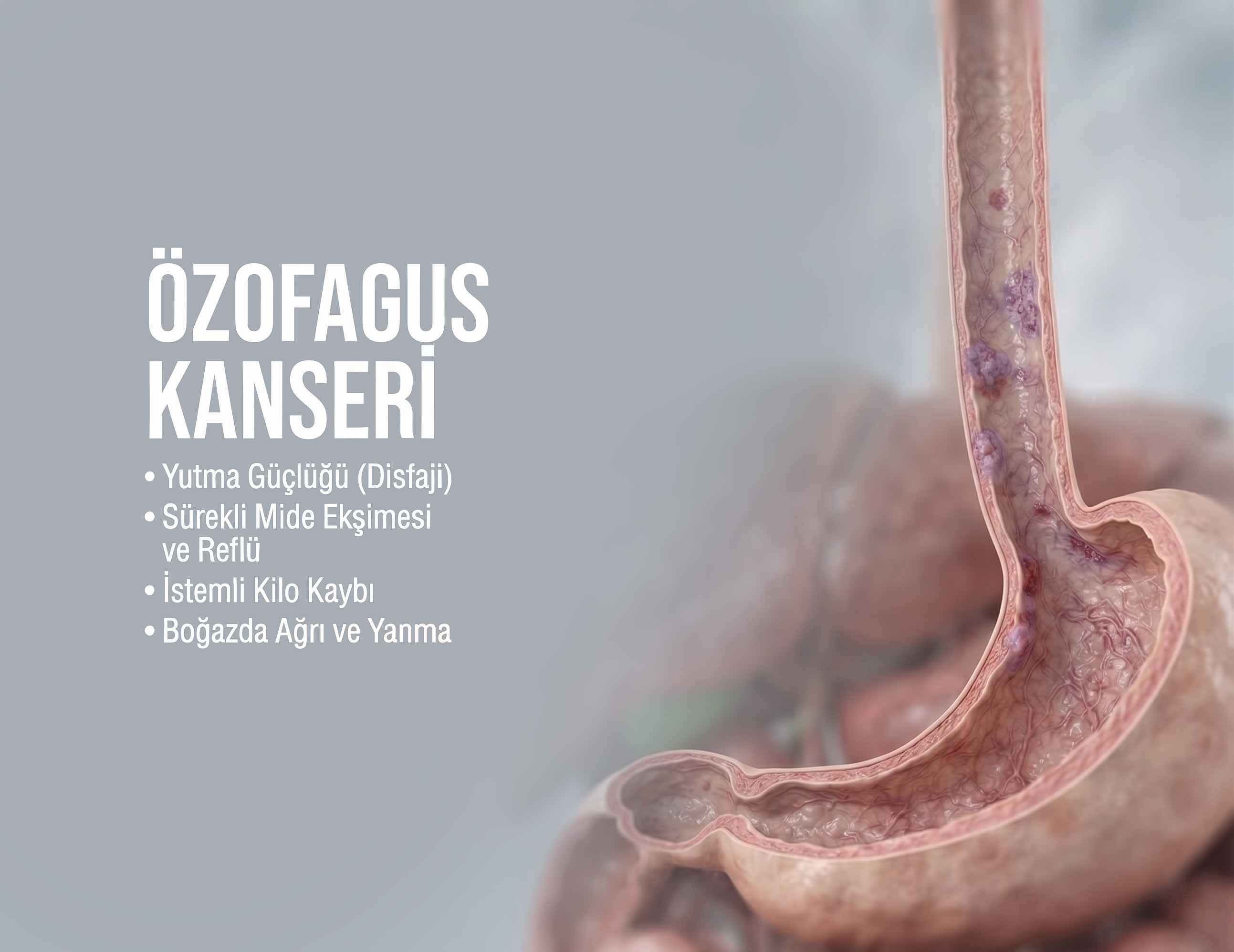 Özefagus (Yemek Borusu) Kanseri Nedir? Belirtileri, Risk Faktörleri ve İstanbul'da Erken Tanının Önemi